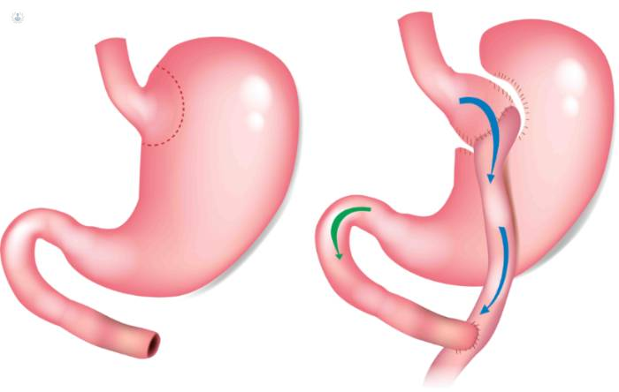 Bypass  Aortocoronario