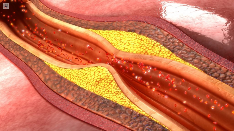 arterioesclerosis