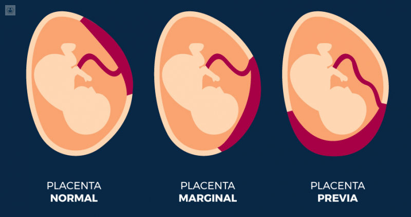 Placenta Previa