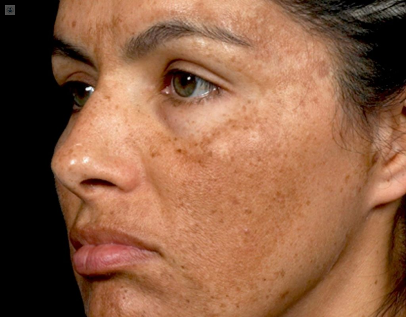 melasma