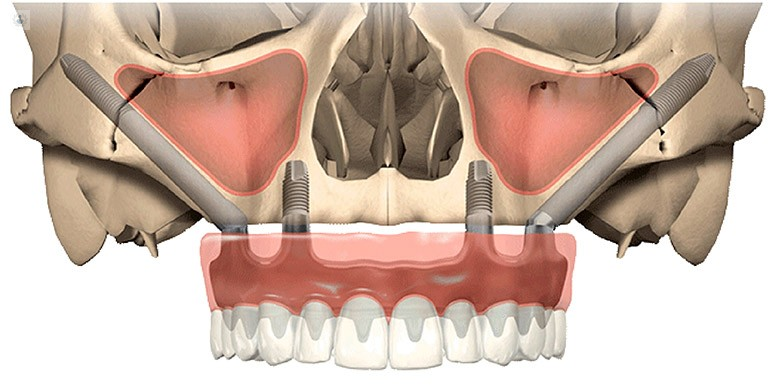 Implantes-Dentales-Cigomáticos