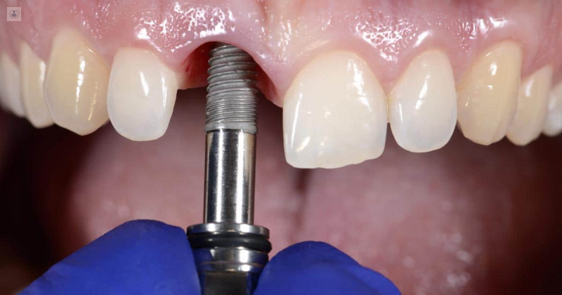 implantologia-dental