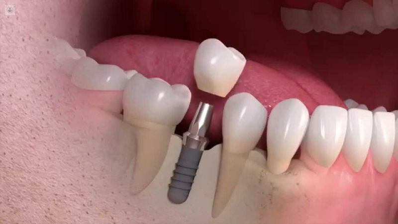 Implantes dentales