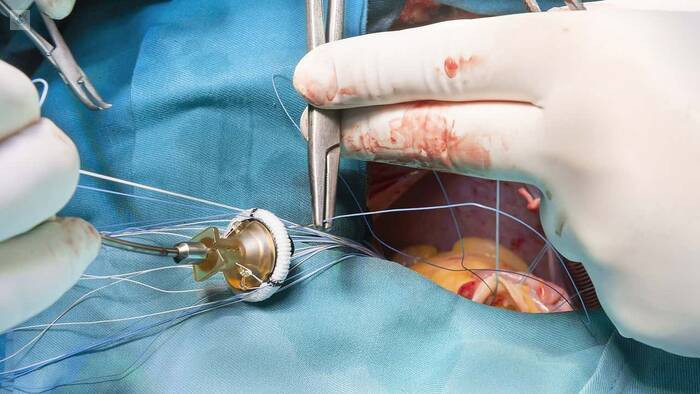 Cirugía Arterial Endovascular